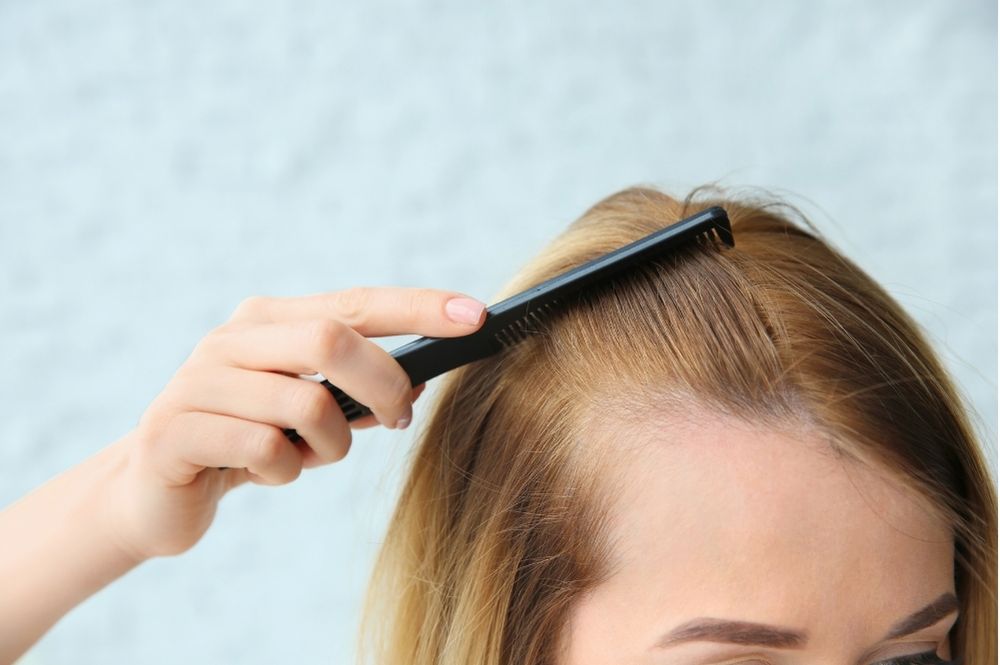 Kadınlarda Saç Dökülmesi Nasıl Engellenir?